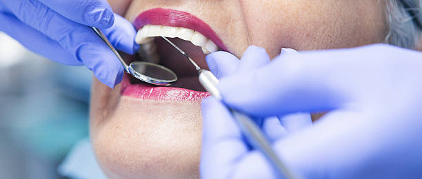 Best Emergency Wisdom Tooth Extraction in Milpitas, CA